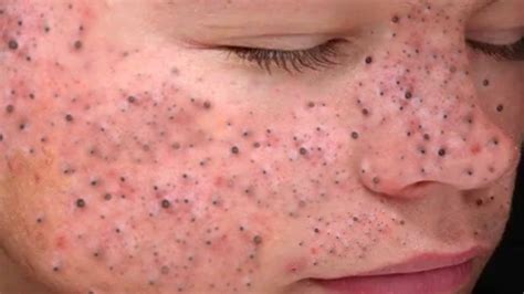 Unbelievable Blackhead Removal 2024: The Hype is REAL! - eq68t6y