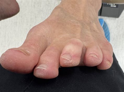 Hammertoe Before and After Photos | Northwest Surgery Center