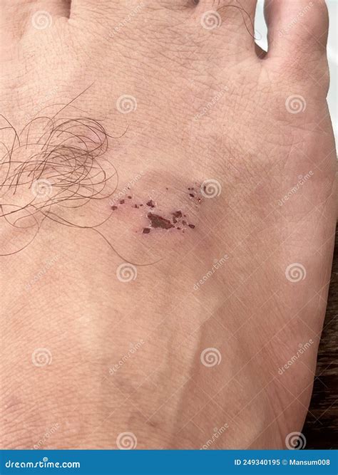 Scar on Skin. the Wound Form Scabs on Leg. Man with Long Scab Wound on
