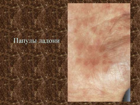 Вторичный период сифилиса - презентация онлайн