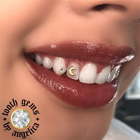 Where Can I Get Permanent Gold Teeth Near Me - abevegedeika
