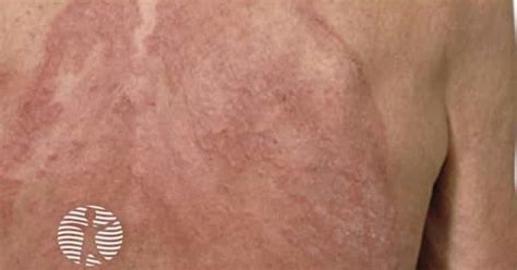 Tinea corporis image