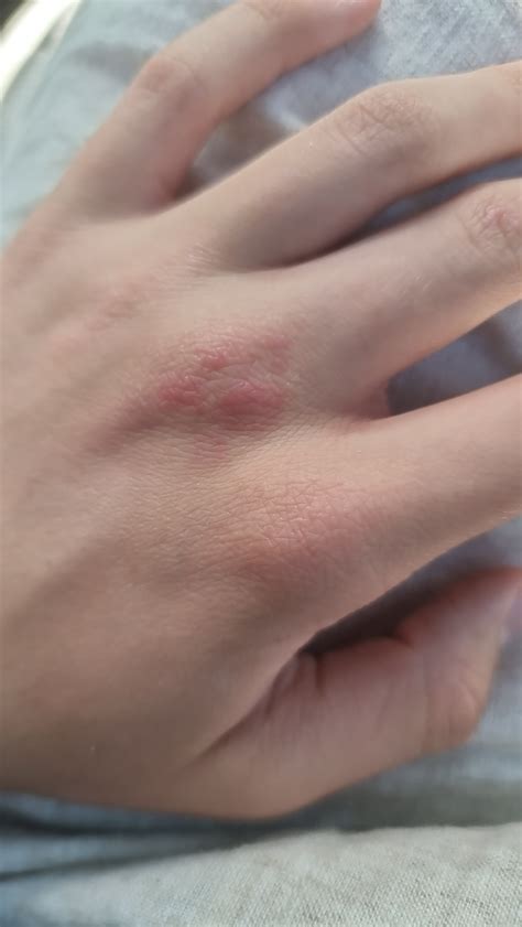 What are these red spots on my hand? : r/DermatologyQuestions