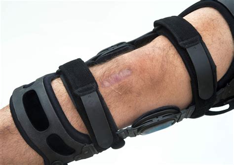 lawyers investigate zimmer tibial plate failure claims