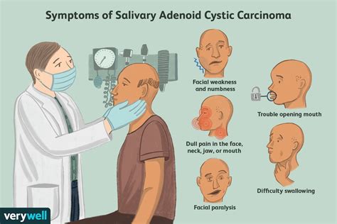 Adenoid Cystic Carcinoma: Types, Symptoms, and Treatment