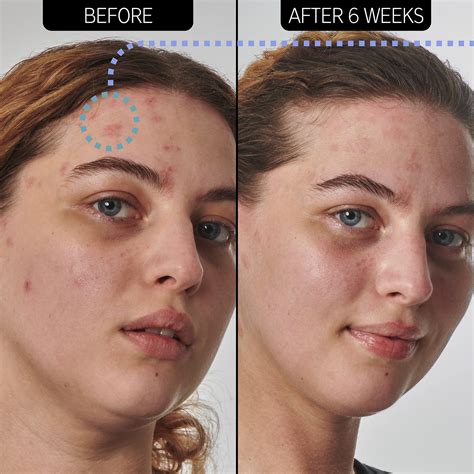 The Inkey List Urea 10% Moisturiser 50ml | Supersolutions | Targets