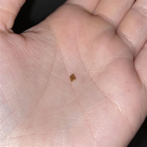 how to pass a kidney stone fast 12