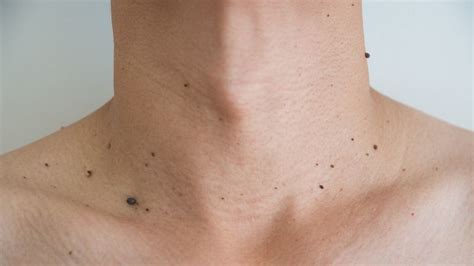 jenis penyakit kulit  tak bisa sembuh total klikdokter