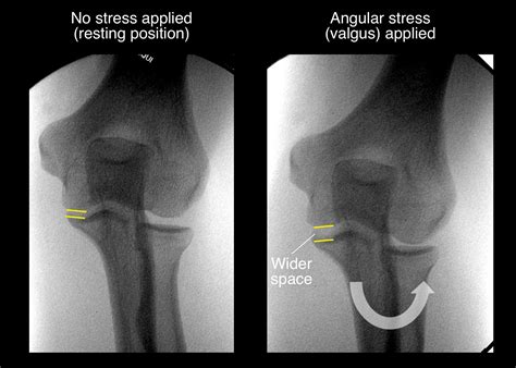 The Tommy John Procedure: How Baseball and Other Throwing Sports May