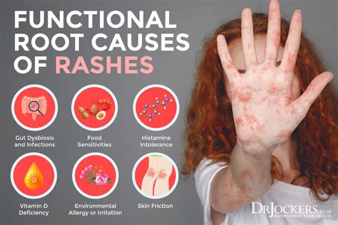 Rash Causes, Causes Of Rashes, Food Sensitivities, Food Allergies, Food ...