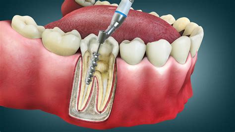 root canal treatment dentevim dental clinic