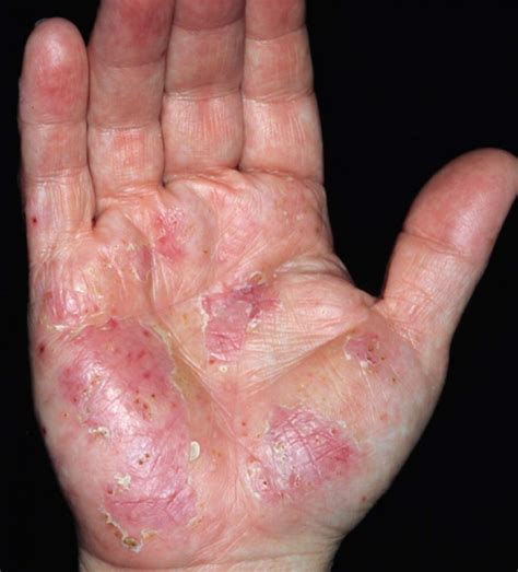Dyshidrotic Eczema Finger