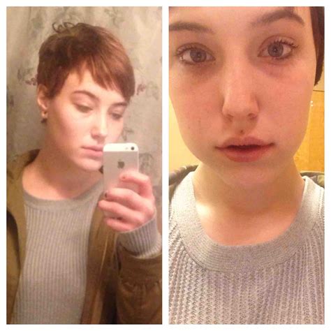 Wisdom Teeth Before And After Face