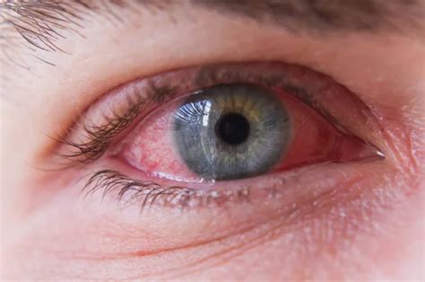 conjunctiva  corneal disease jyotieyehospitalin