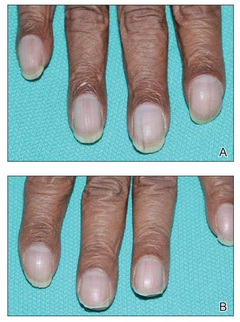 Normal Fingernails