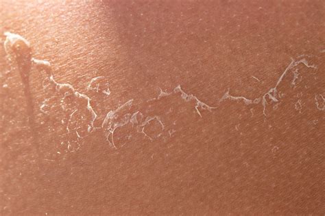 Peeling De Diamante Antes E Depois 1 Sessão - Peeling Skin: Causes & Treatments | U.S. Dermatology Partners