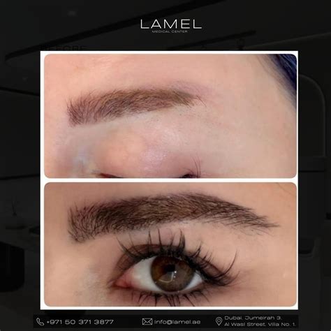 eyebrow transplant  dubai lamel medical center