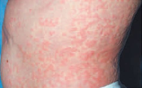Maculopapular Rash Pictures Causes Treatment Medical Pictures Info
