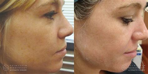 Forever Young® BBL + HALO® Laser | Feinstein Dermatology