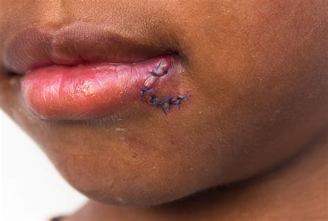 Vermilion Border Fungal Infection Inflammatory Conditions Of The Oral