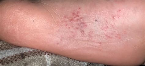 Cluster Of Red Spots On Foot Store | emergencydentistry.com
