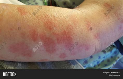 erythema multiforme image photo  trial bigstock