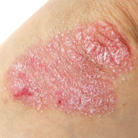 Psoriasis Treatment | Devonshire Dermatology | London