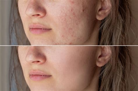 Premium Photo | Teenage girl before and after acne treatment skin care ...