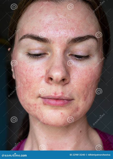 The Skin Of A Patient With Papulopustular Rosacea, Full Face Royalty