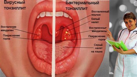 💊 Ангина лечение 💊 Гнойная ангина 💊 Тонзиллит 💊 Доктор Кострик ...