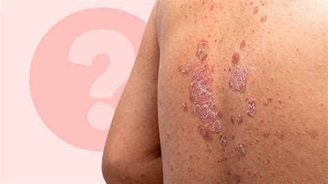 generalized pustular psoriasis gpp symptoms