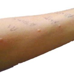 Skin testing showing immediate hypersensitivity reaction to Aspergillus ...