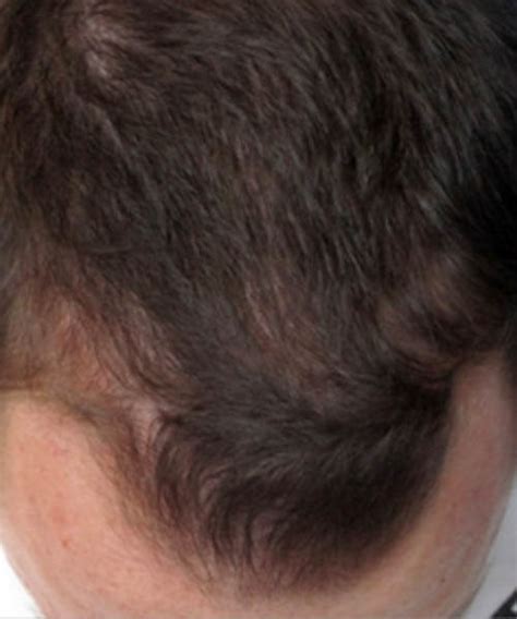 Hair Restoration Before and After | See Photos | LaserCap