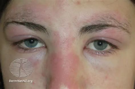 Dermatomyositis – JAISALMERNEWS.COM