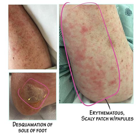 Drug Reaction With Eosinophilia And Systemic Symptoms