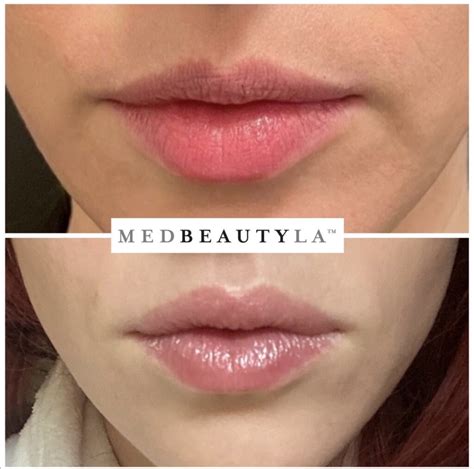 lip flip botox   afters