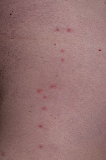 Carrapato No Corpo Humano - Foto de Linha De Picadas De Carrapato No Lado Do Torso e mais fotos de ...