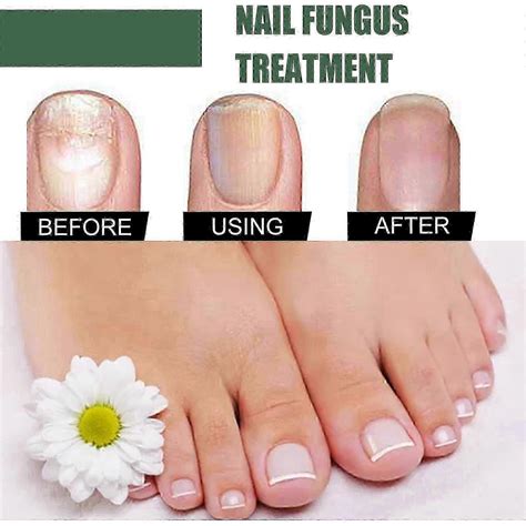 Extra Strong Nail Fungus Treatment, Best Nail Repair Stops Fungus
