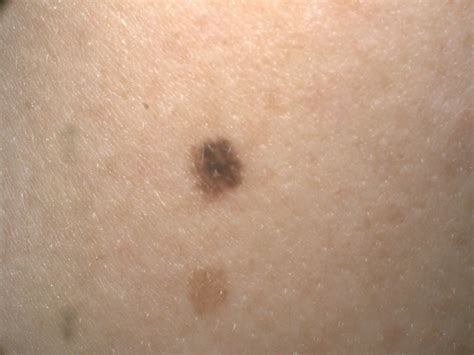 Why you need to get your moles checked! - Diversions