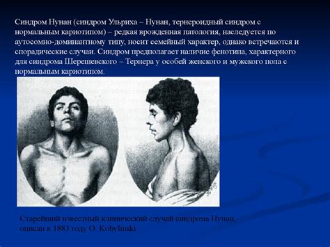 Синдром Ульриха-Нунана - презентация онлайн