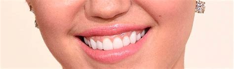 Does Miley Cyrus have veneers? - Dentakay