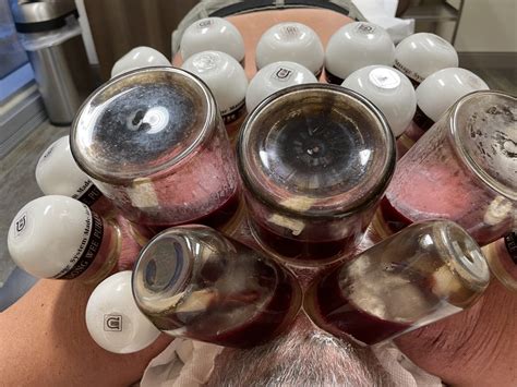An Overview of Cupping Therapy | Modern Cupping Therapy