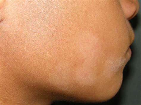 White Rash on Skin: Fungus, Sun, and More