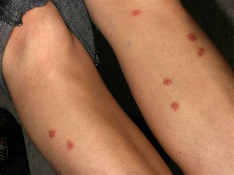 Itchy Bumps On Skin Like Mosquito Bites: What Are They?, 58% OFF