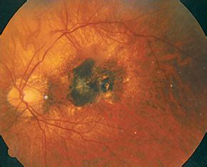 Fundoscopic Exam Abnormal Findings