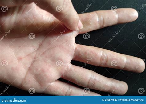 Dyshidrotic Eczema Eczema Rash Doctor – Bilarasa