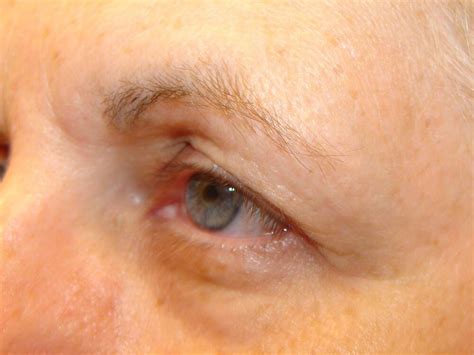 Blepharoplasty Before and After in Rancho Santa Margarita, CA | OCSS