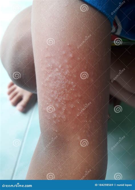 Rash On Children Legs Close-up, Redness Of The Skin, Allergic Reaction