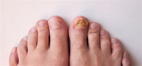 Mycose des ongles - Votre clinique podiatrique à Sherbrooke