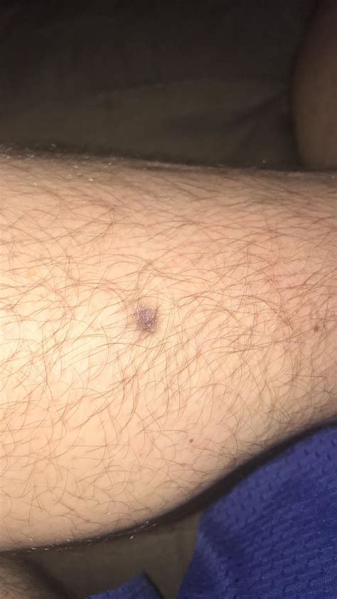 Lump Under Skin On Calf at Diane Carey blog